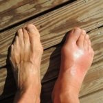 5 Buah Ampuh Turunkan Asam Urat Tinggi Secara Alami, Tanpa Obat Kimia