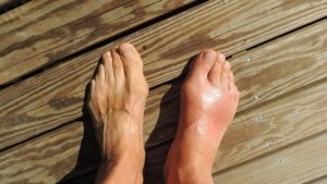 5 Buah Ampuh Turunkan Asam Urat Tinggi Secara Alami, Tanpa Obat Kimia