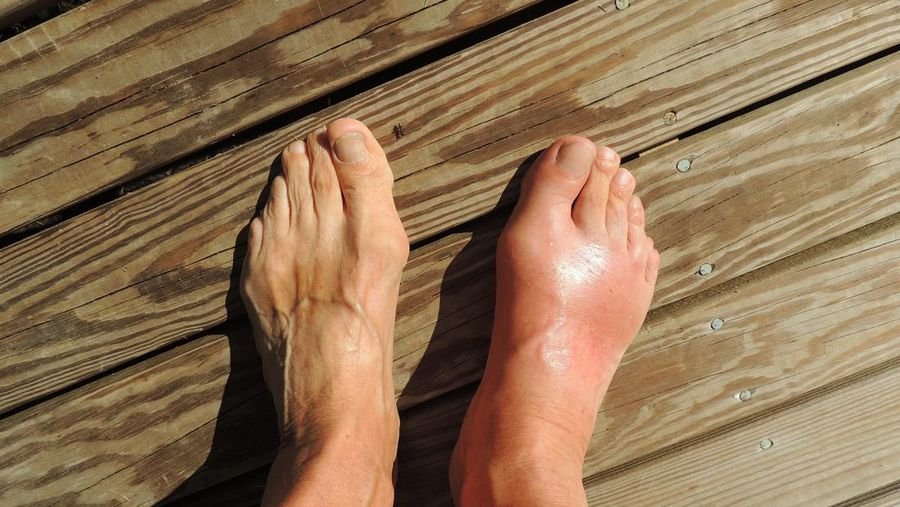 5 Buah Ampuh Turunkan Asam Urat Tinggi Secara Alami, Tanpa Obat Kimia