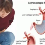 8 Pantangan GERD yang Wajib Dihindari agar Asam Lambung Tidak Kambuh