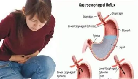 8 Pantangan GERD yang Wajib Dihindari agar Asam Lambung Tidak Kambuh