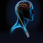 Parkinson dan Teknologi Nanobubble: Potensi Mendukung Fungsi Saraf dan Kualitas Hidup