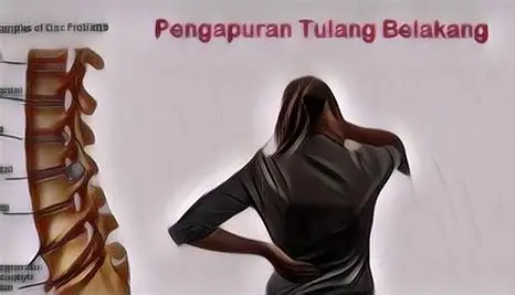 Tubuh Sering Nyeri dan Kaku? Bisa Jadi Tanda Pengapuran Tulang